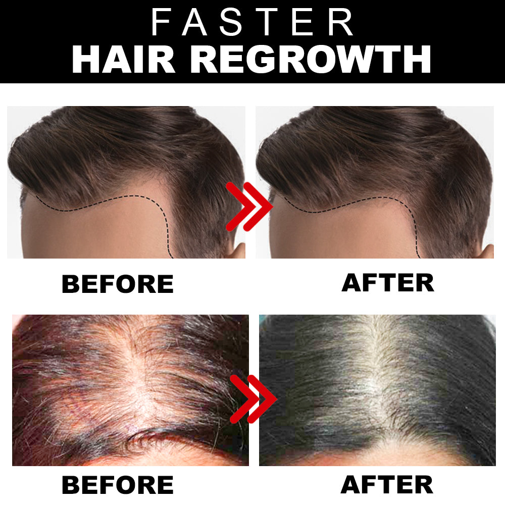 Hair Growth Serum with 5% Redensyl, Anagain & Procapil for Men & Women